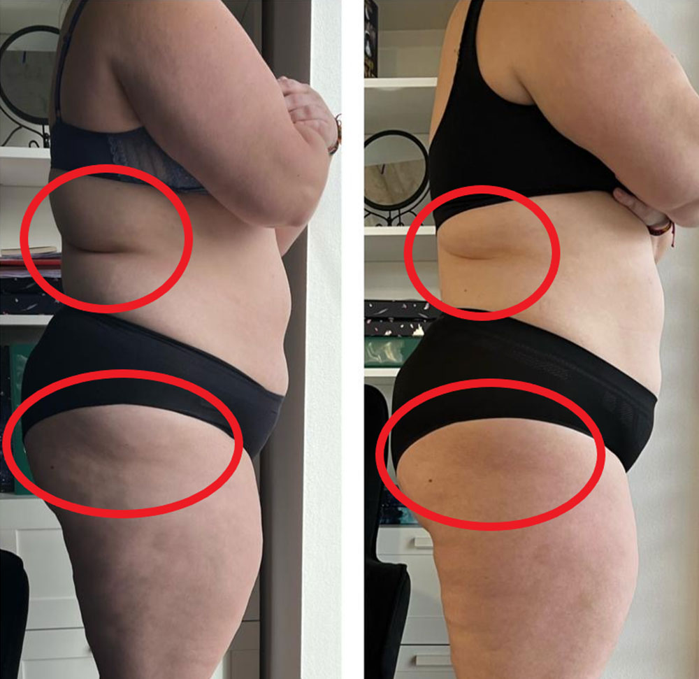 výsledok anticelulitídnej antifibrotickej masáže po 5 procedúrach Image